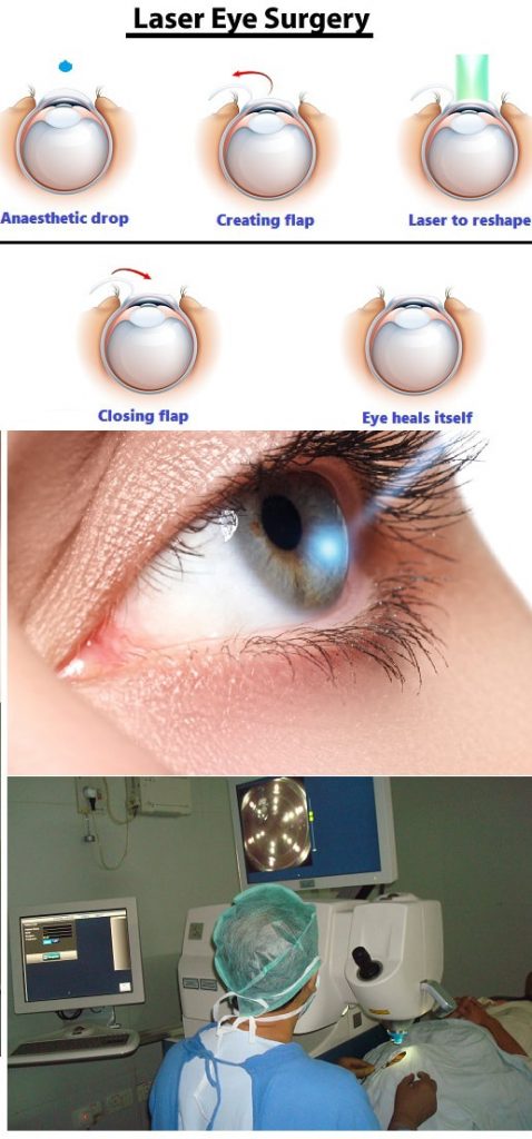 Laser eye surgery in ghaziabad