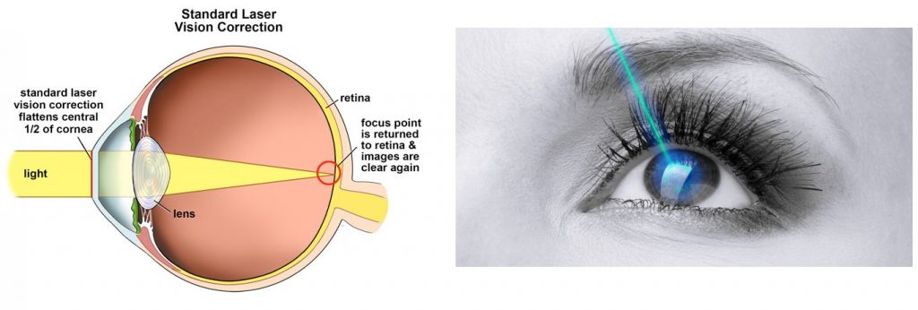 How Smile Laser Eye Medical Procedure Functions | Vedanta Netralya