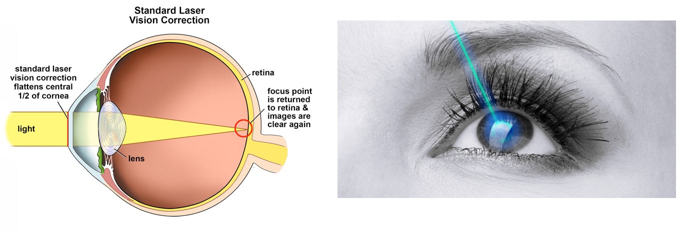 How Smile Laser Eye Medical Procedure Functions